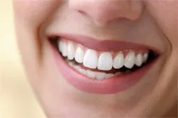 29312 take home whitening kits