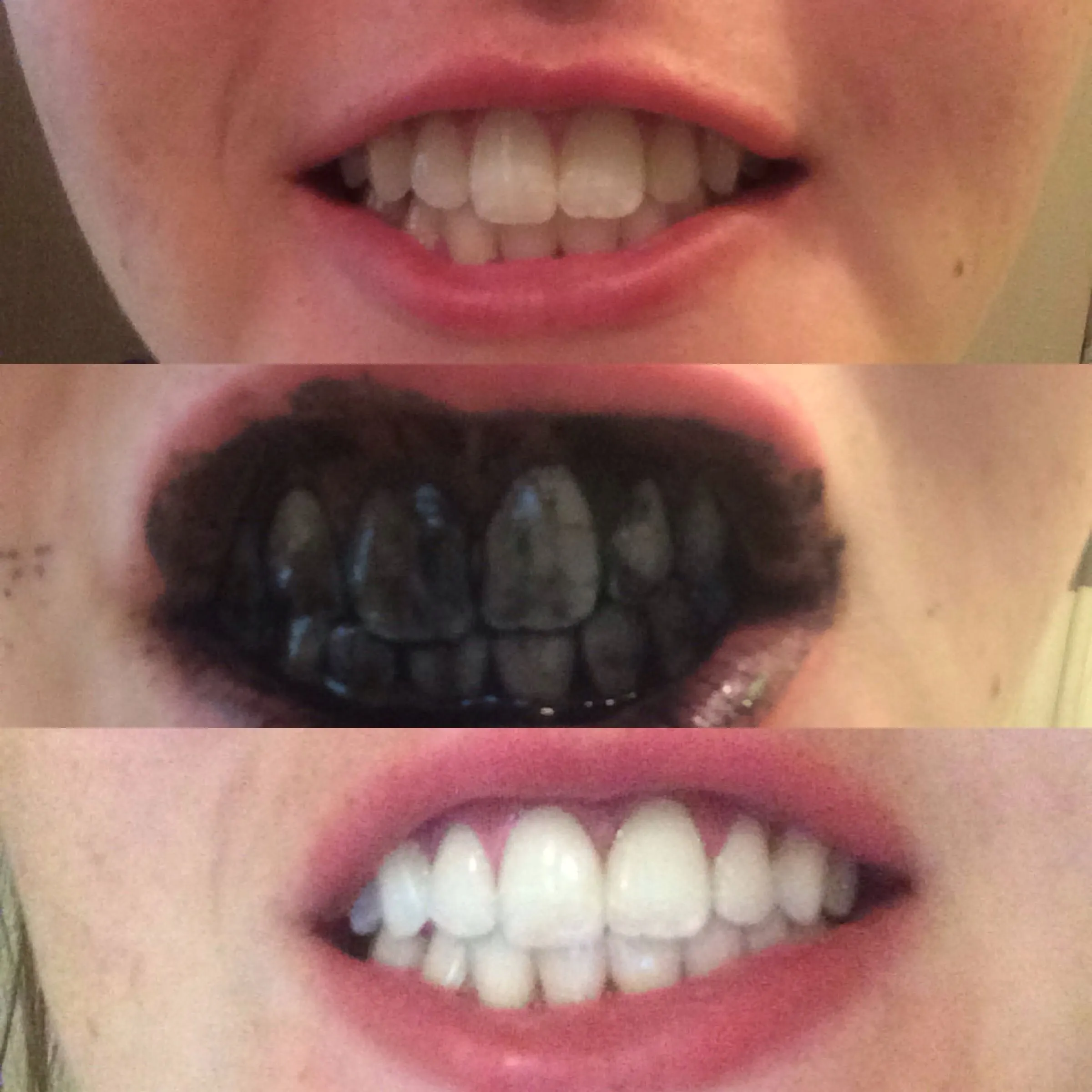29313 smile with activated charcoal
