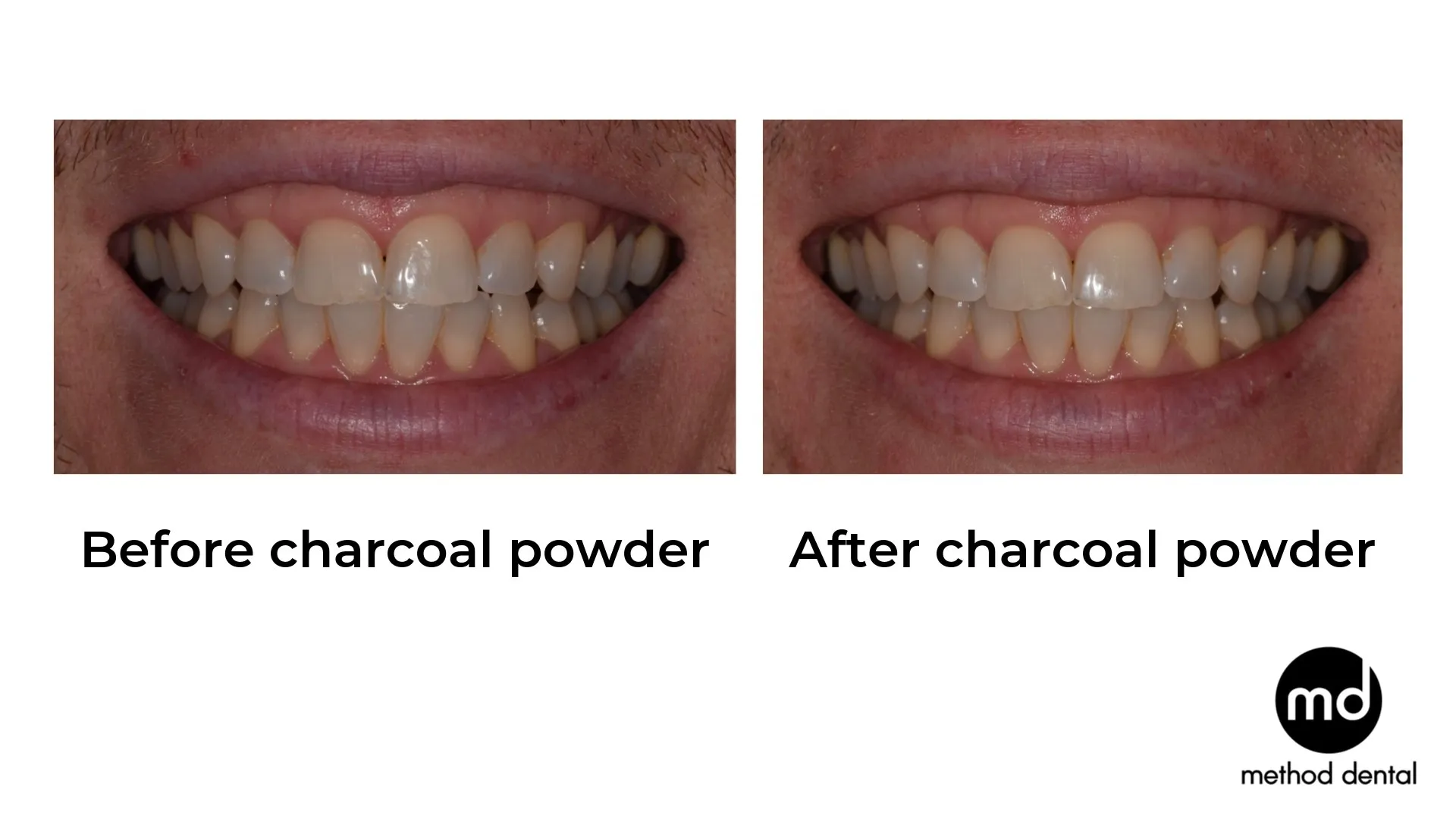 29313 teeth before and after