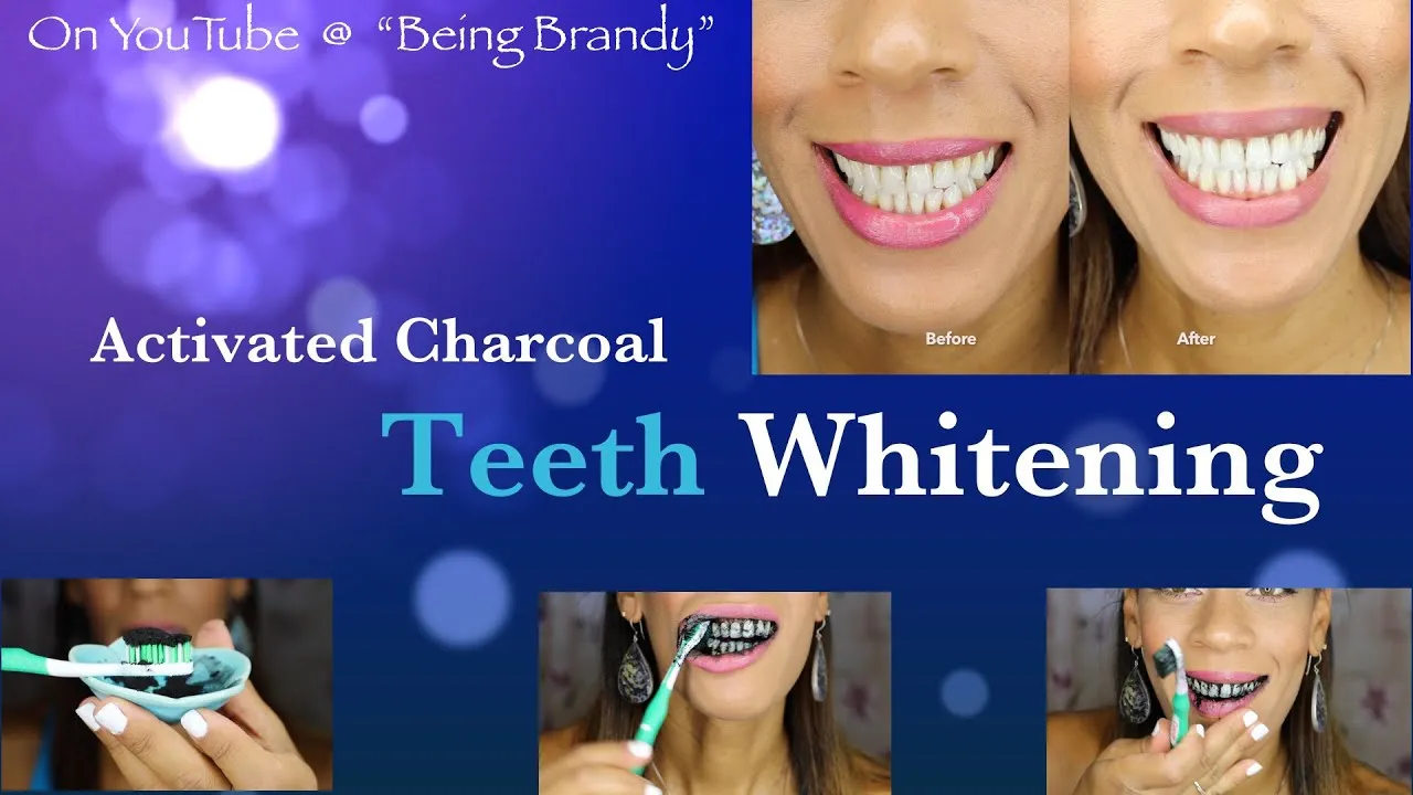29313 teeth whitening comparison