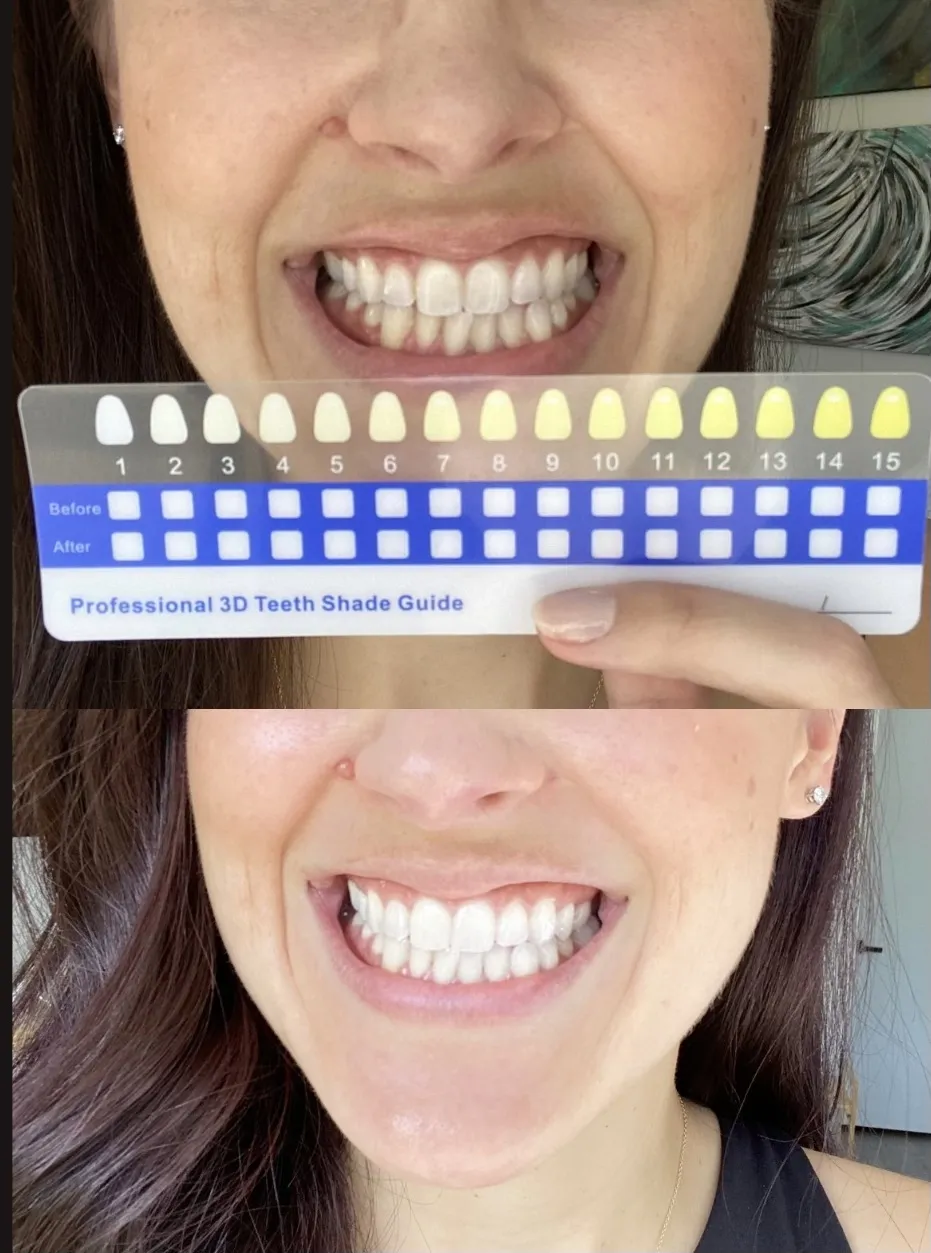29315 professional teeth whitening