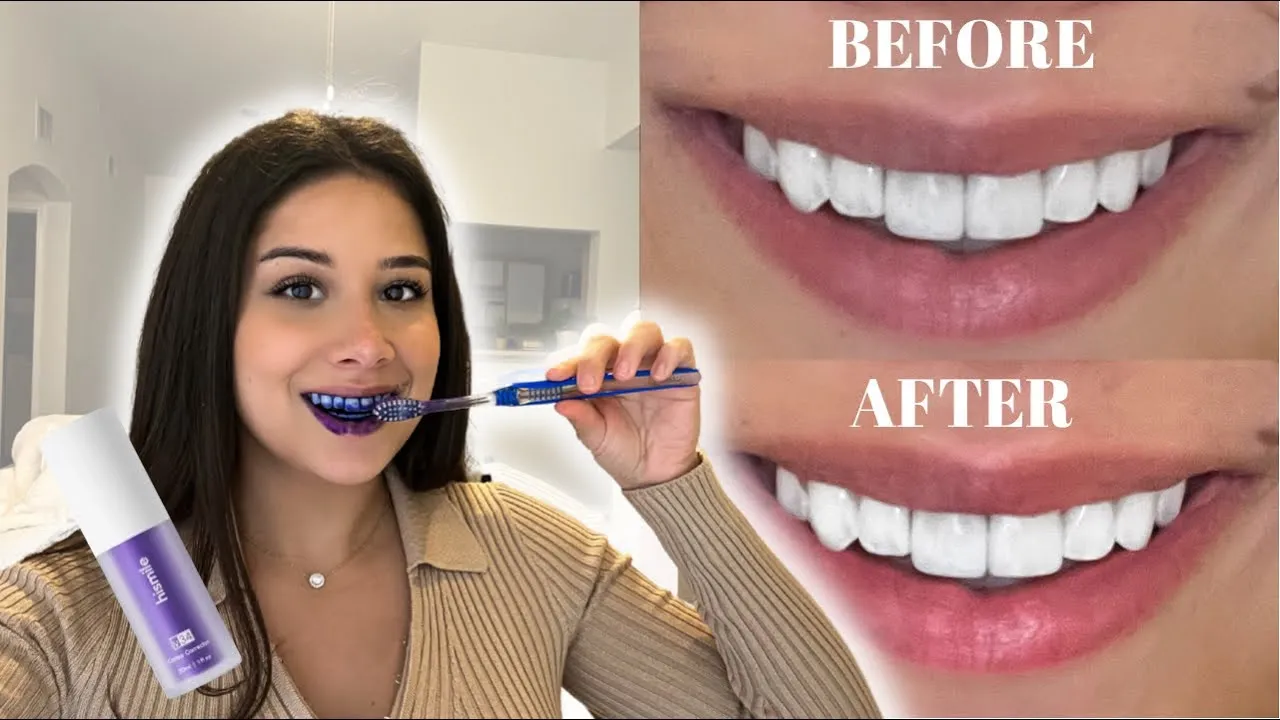 29315 tiktok teeth whitening before and after
