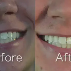 /img/29319-realistic-teeth-whitening.webp