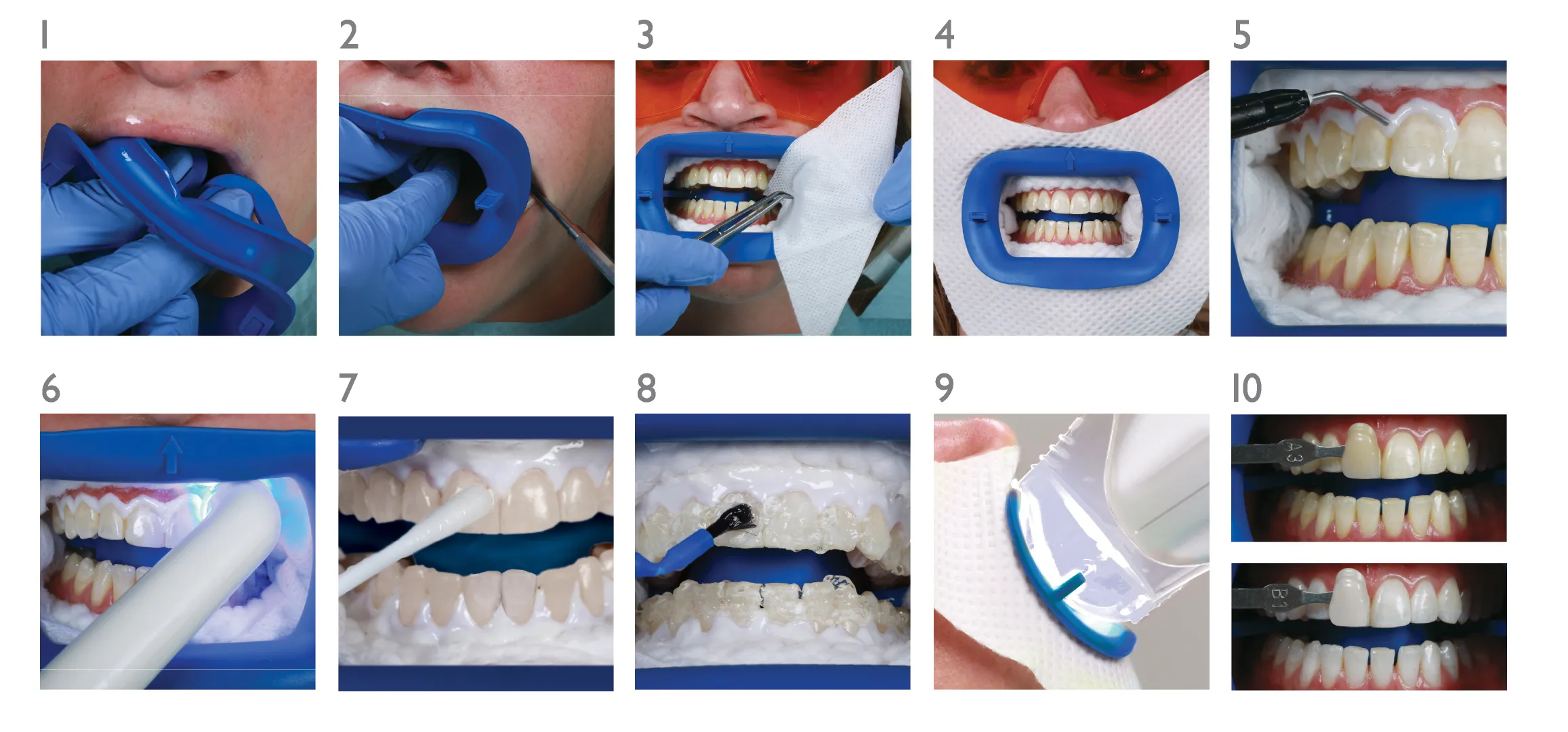 29320 at home teeth whitening