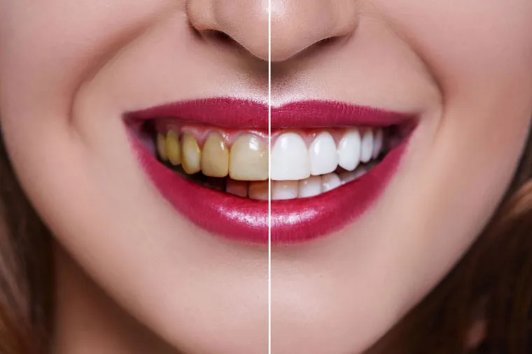 /img/29320-maintaining-white-smile.webp