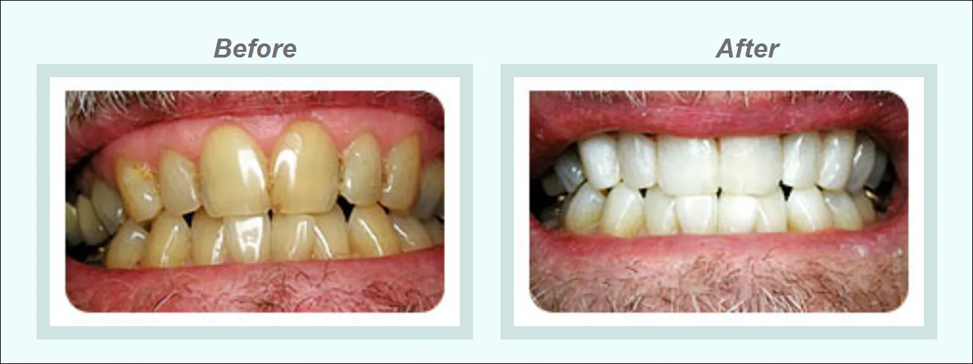 29320 teeth whitening cost
