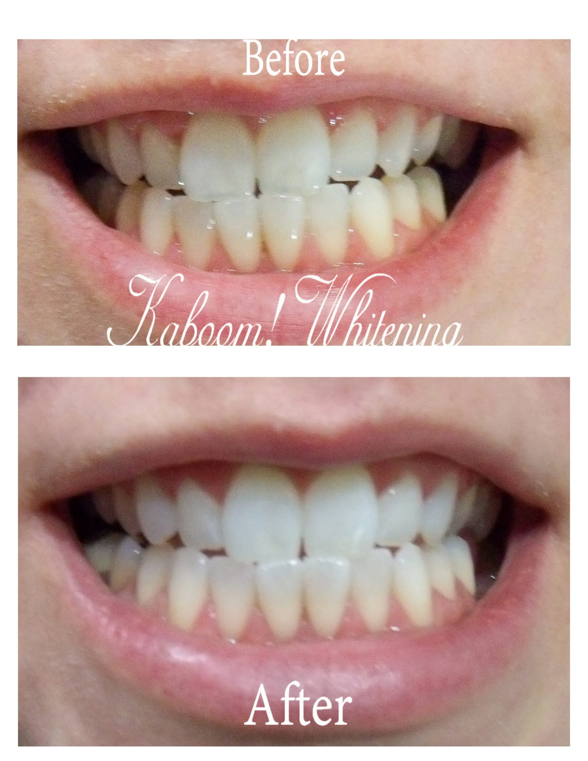 29325 at home whitening