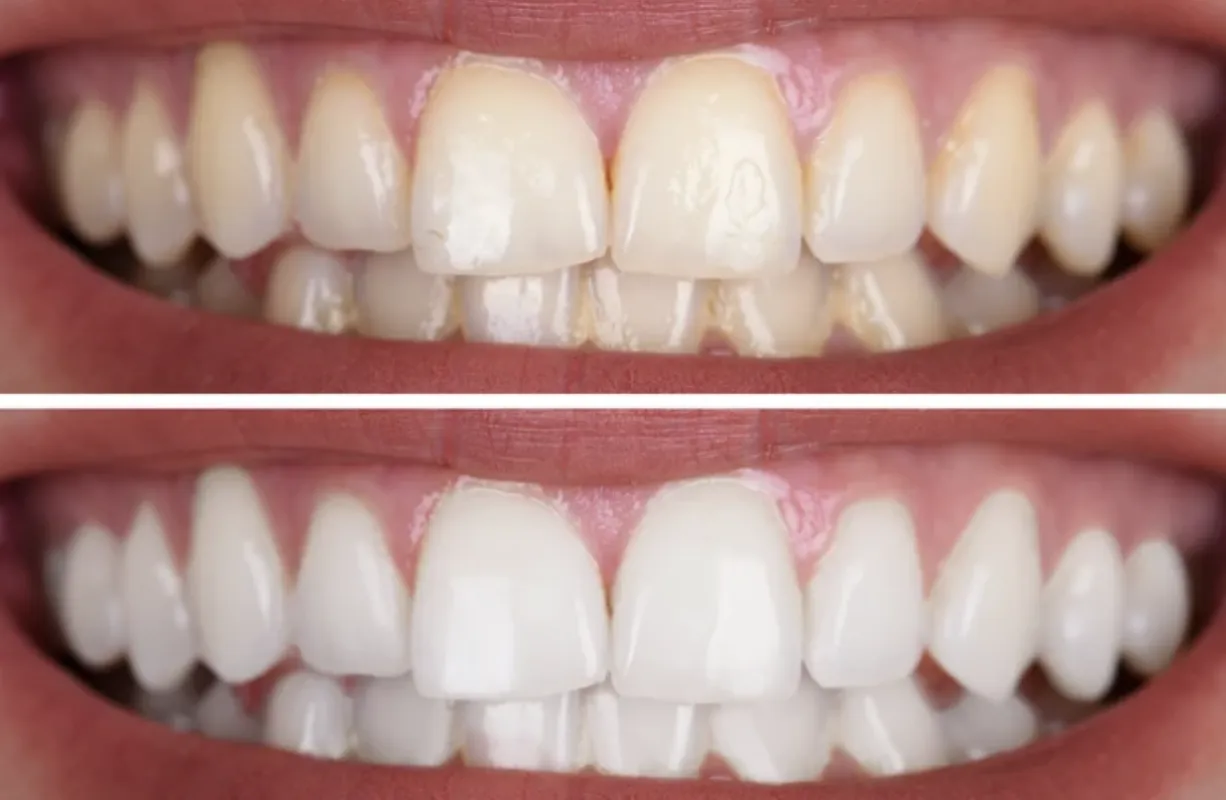 29325 dental cleaning
