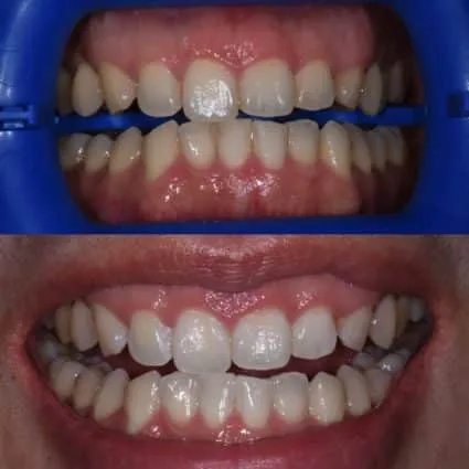 29325 tooth whitening nyc