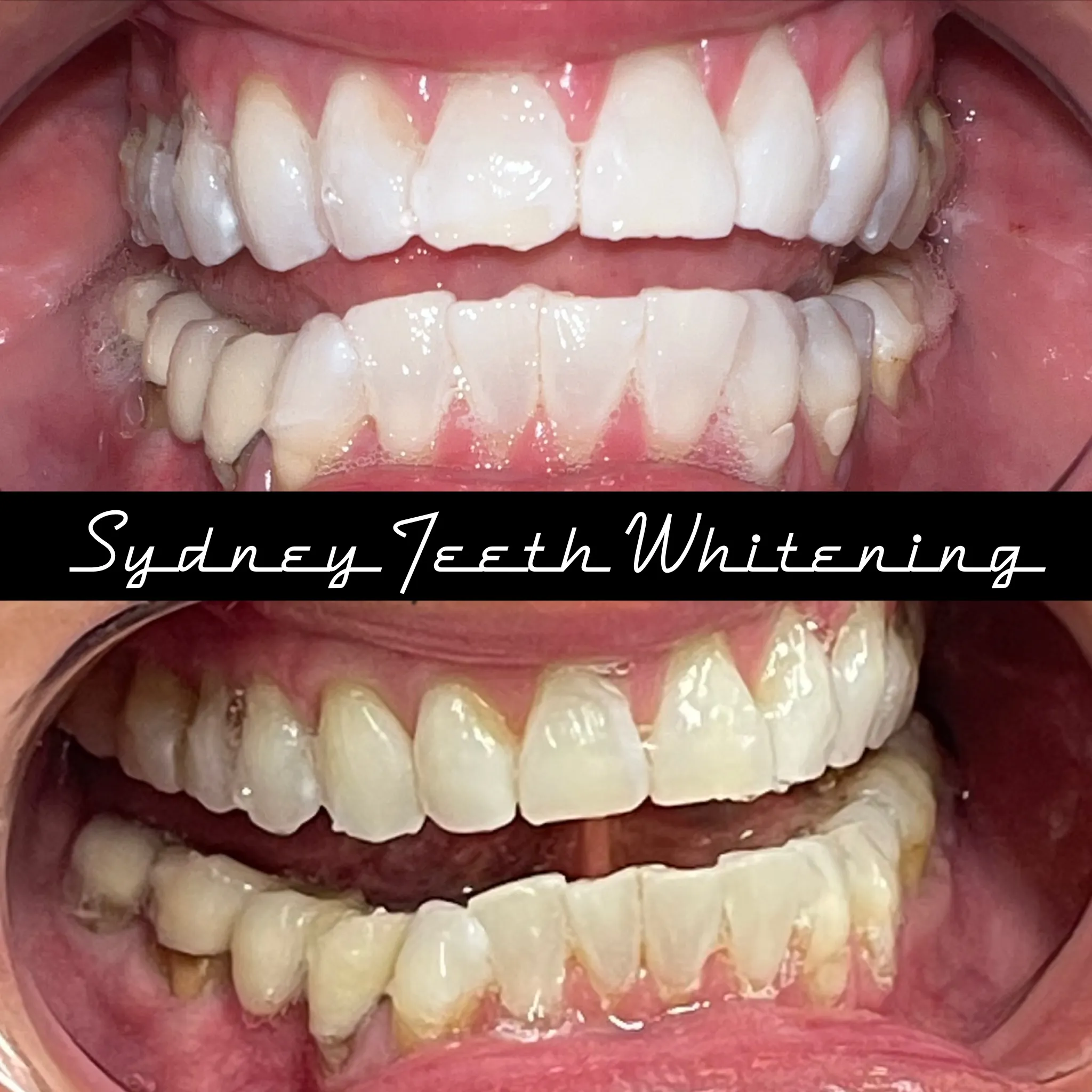 29326 teeth whitening specialist smile