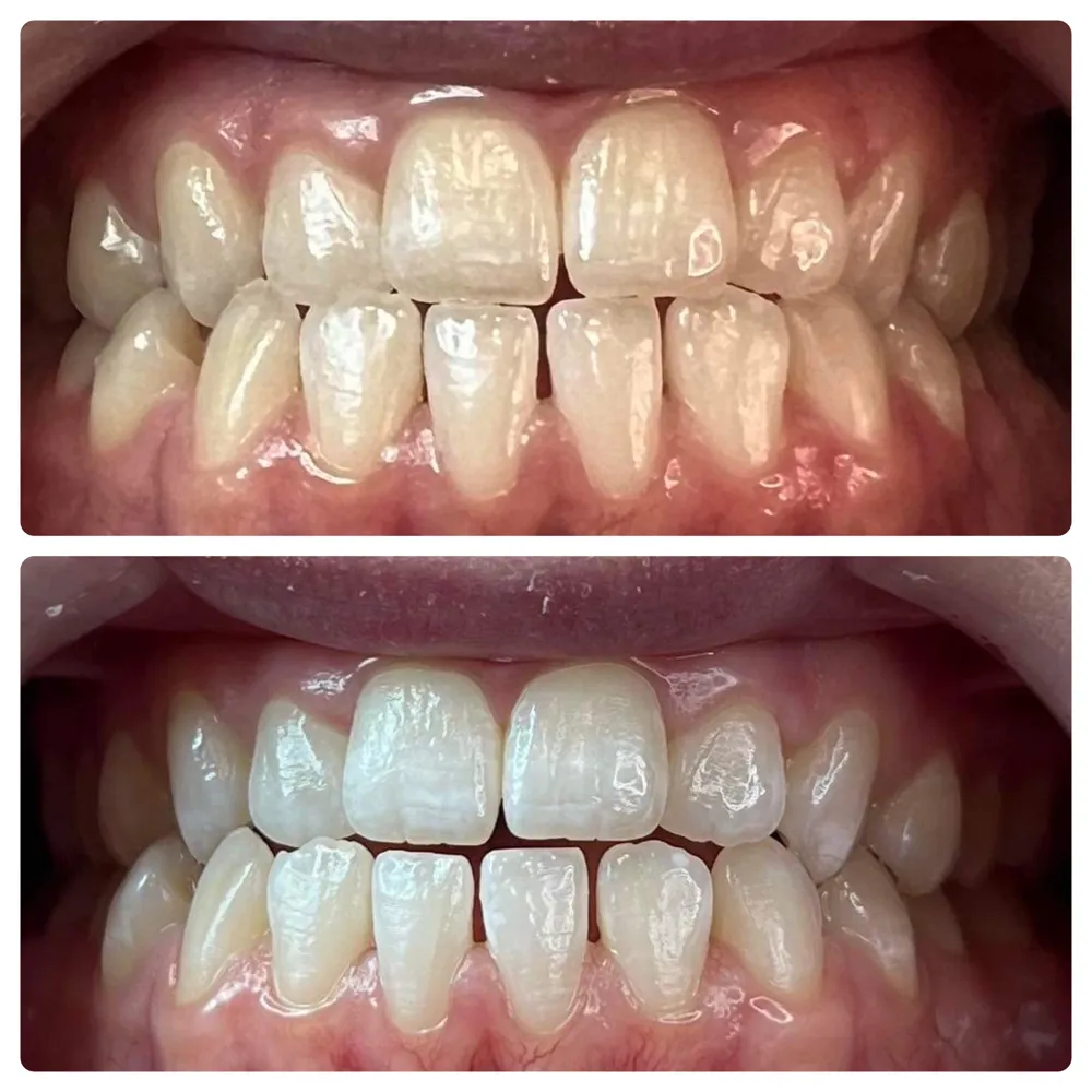29335 teeth whitening green bay cost