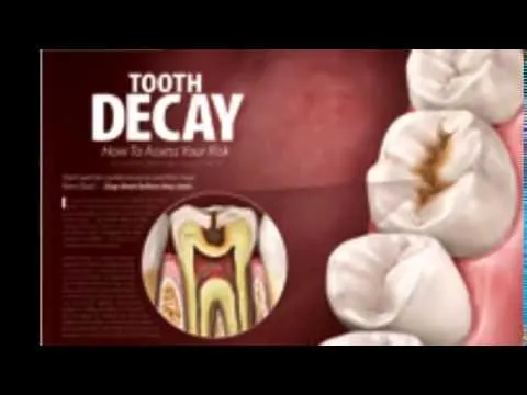 29335 teeth whitening green bay in office