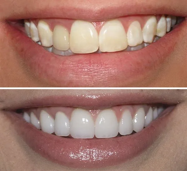 /img/29337-teeth-whitening-alternatives.webp