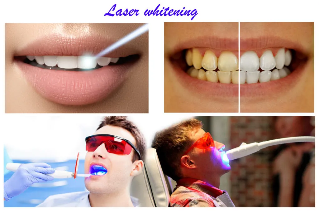 29337 teeth whitening cost