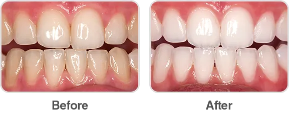 29340 boost whitening before and after