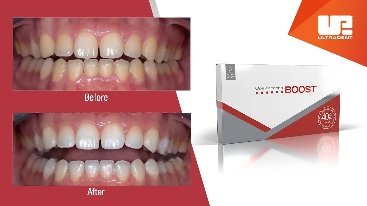 29340 boost whitening procedure