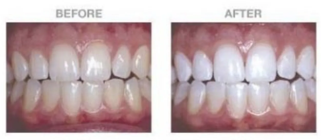 29340 oral hygiene boost whitening
