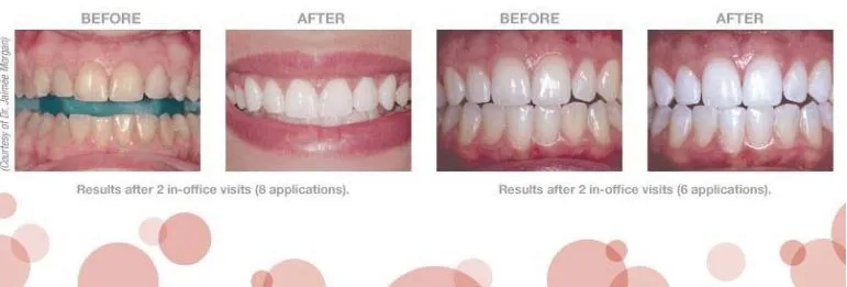29340 teeth whitening consultation