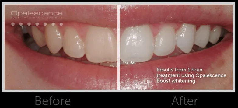 29340 whitening sensitivity