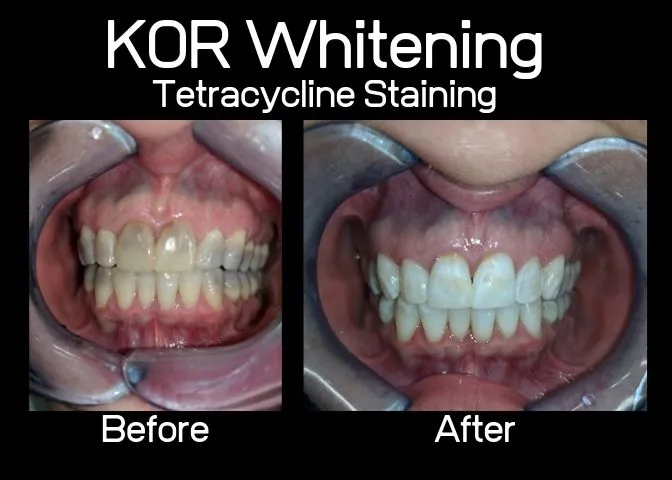 29344 kor whitening dentist