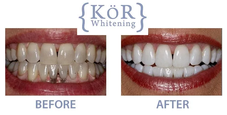 29344 kor whitening patient