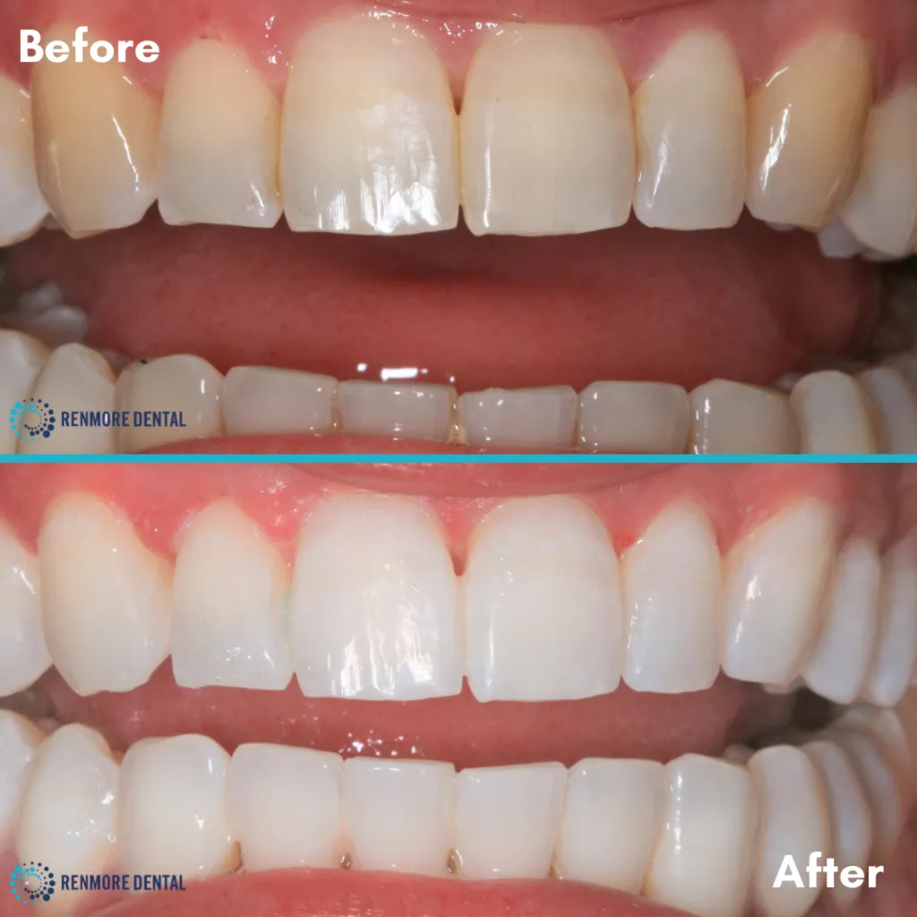 29344 kor whitening smile