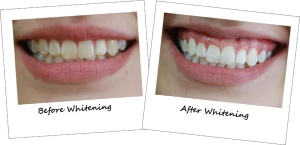 29345 laser teeth whitening aftercare