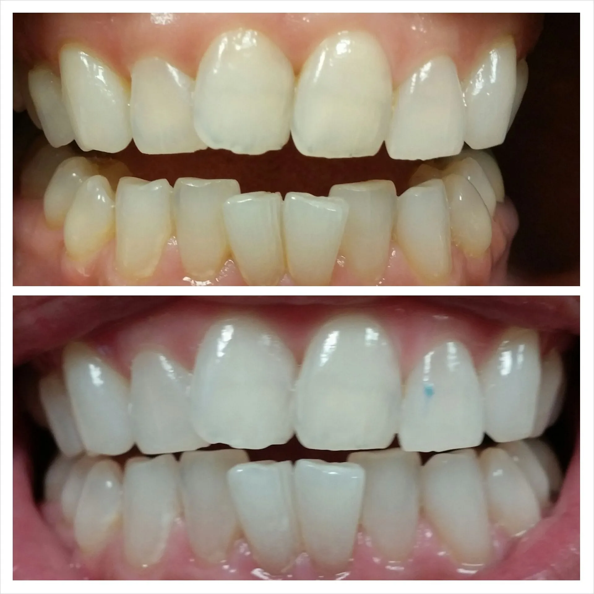 29345 laser teeth whitening procedure