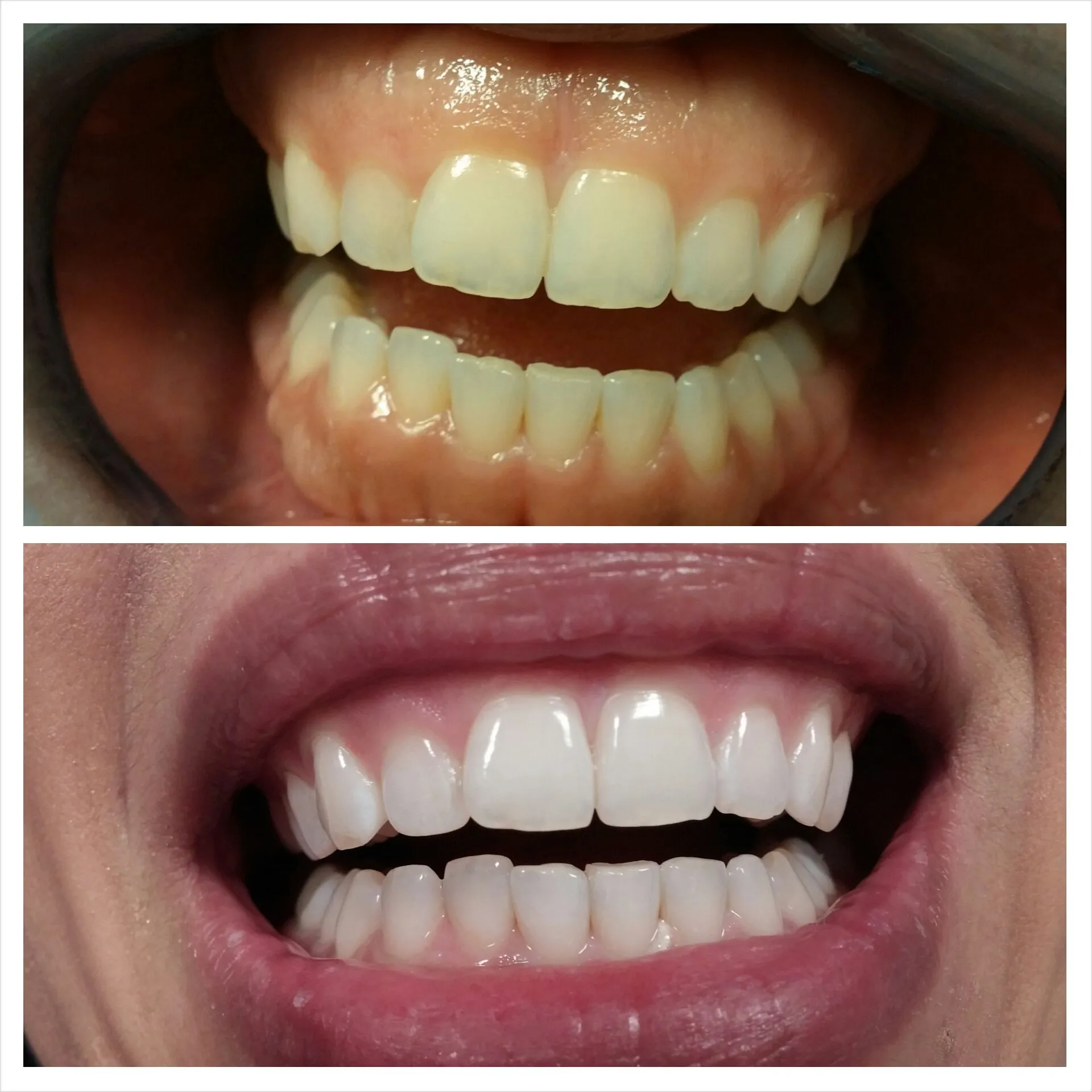 29345 laser teeth whitening pros and cons