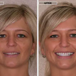 /img/29345-teeth-whitening-smile.webp