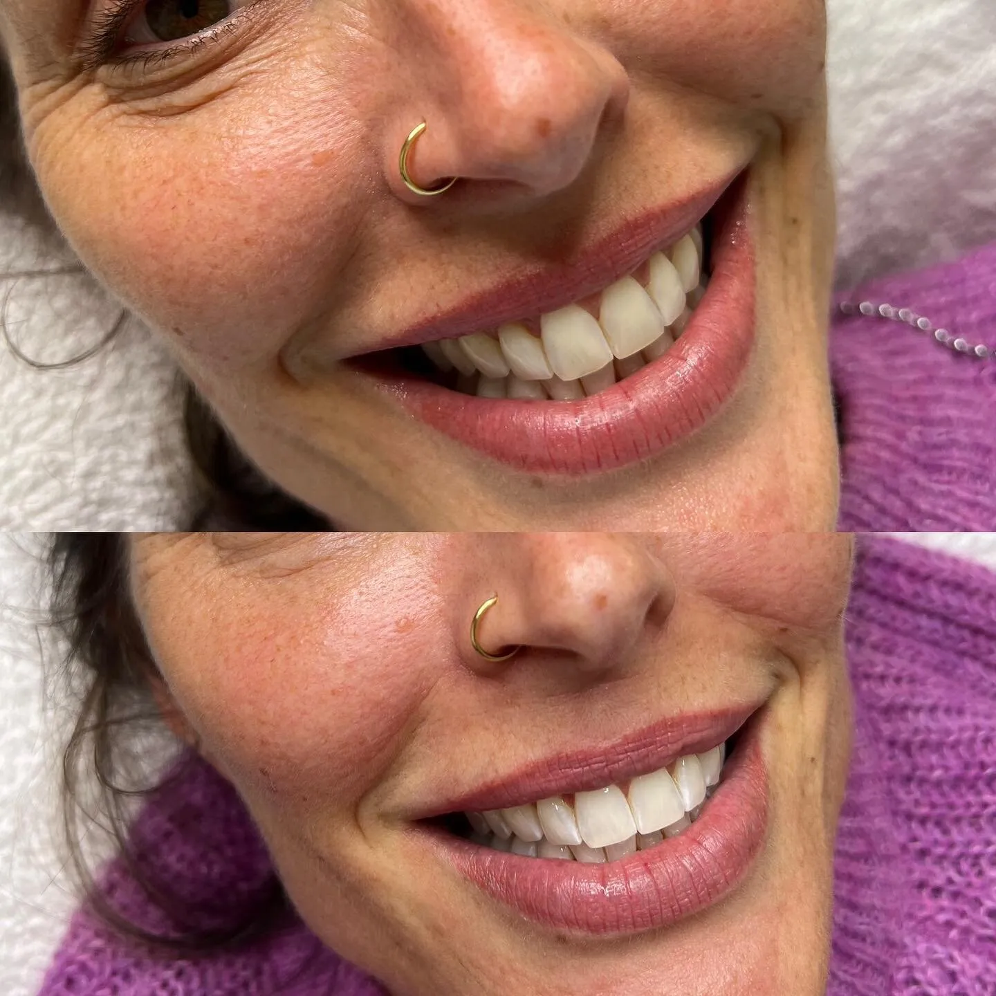29348 professional teeth whitening