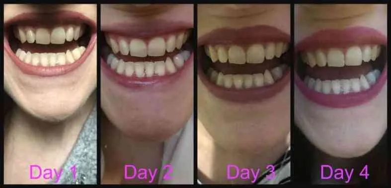 29349 snow teeth whitening uk convenience