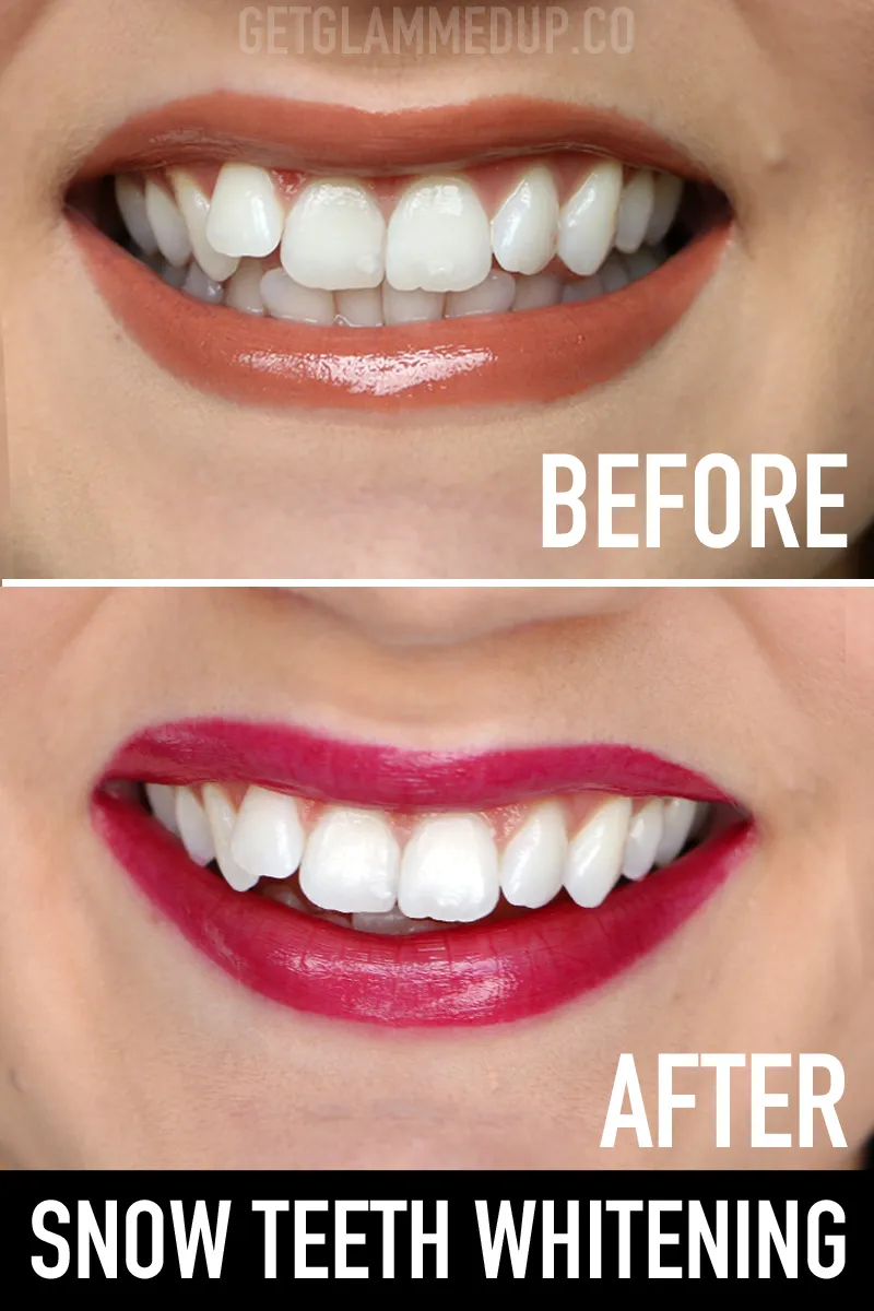 29349 snow teeth whitening uk oral health