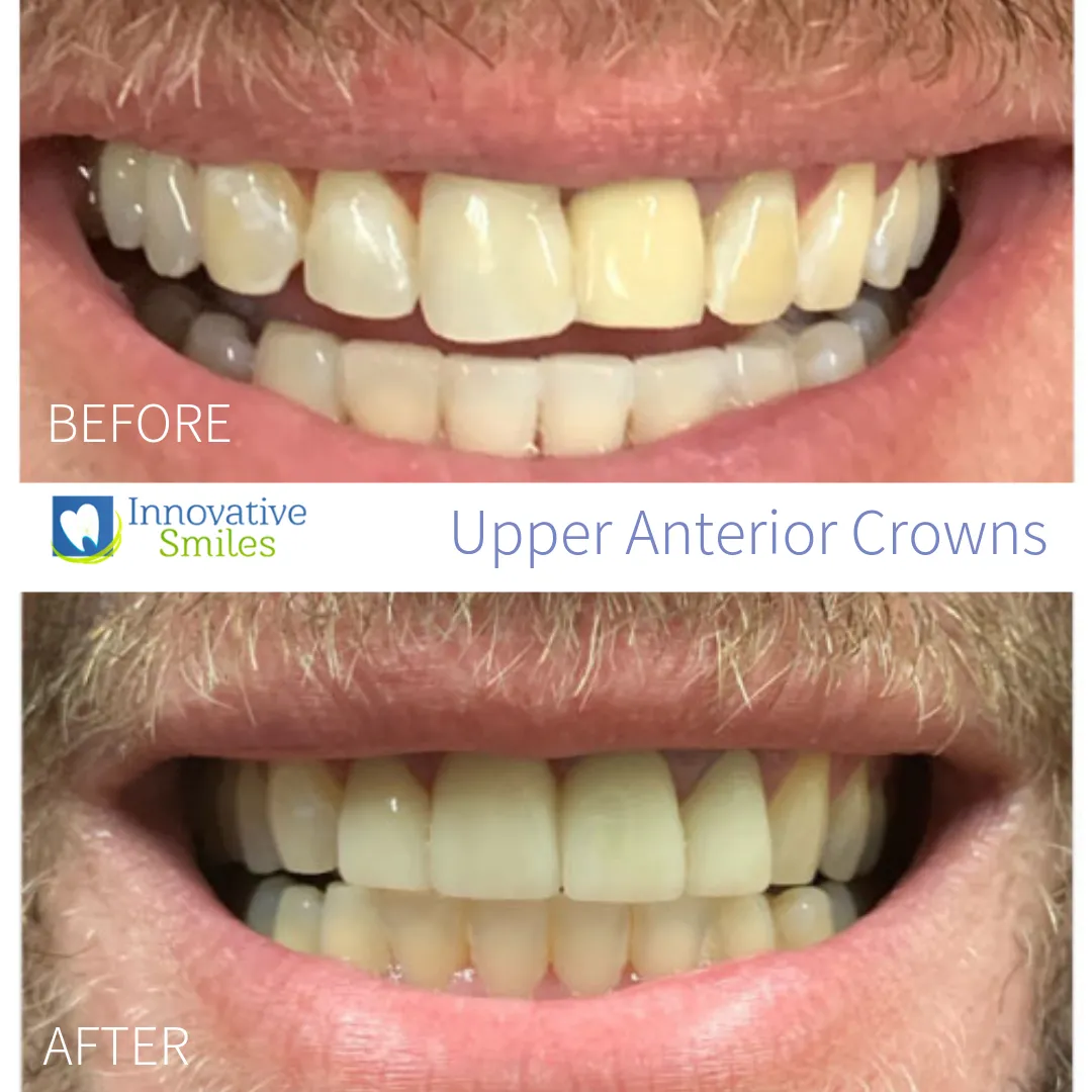 29352 dental crowns illustration