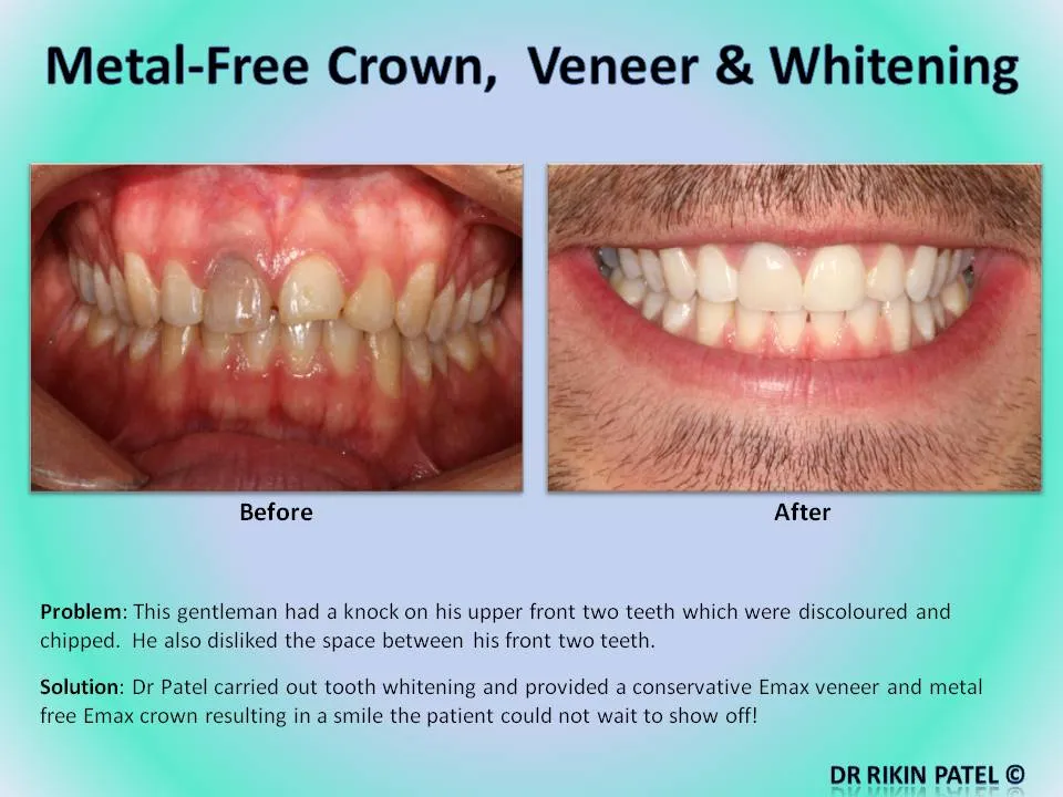 29352 veneers alternative